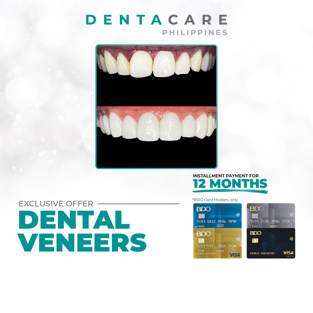 Veneers Installment Promo