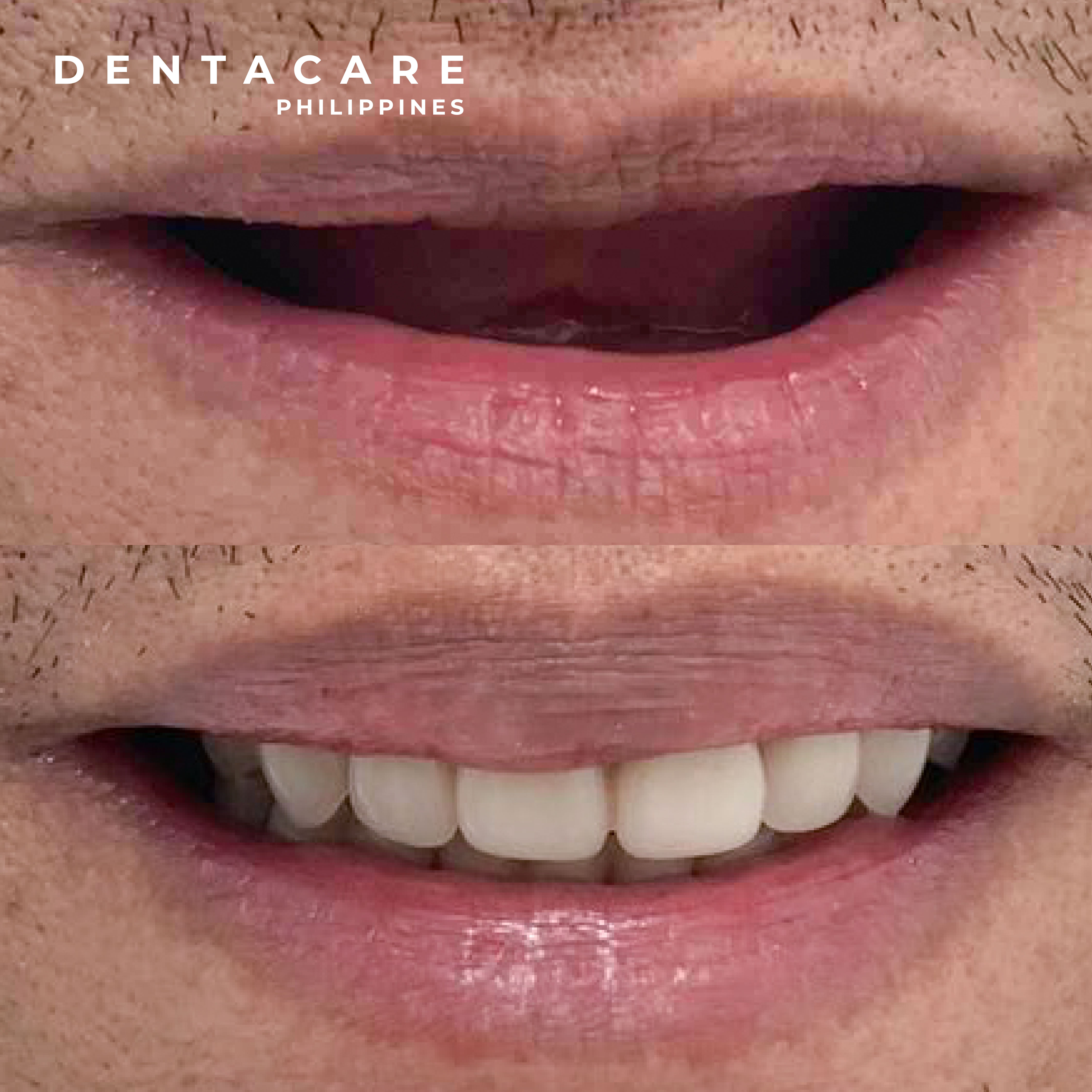 Teeth Whitening or Veneers? Here’s Everything You Need To Know About Achieving the Perfect Smile