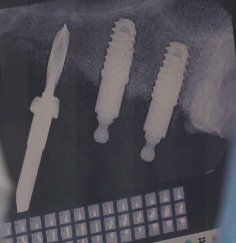Permanent tooth replacement options: Why dental implants lead the way